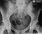 Osteopoikilosis